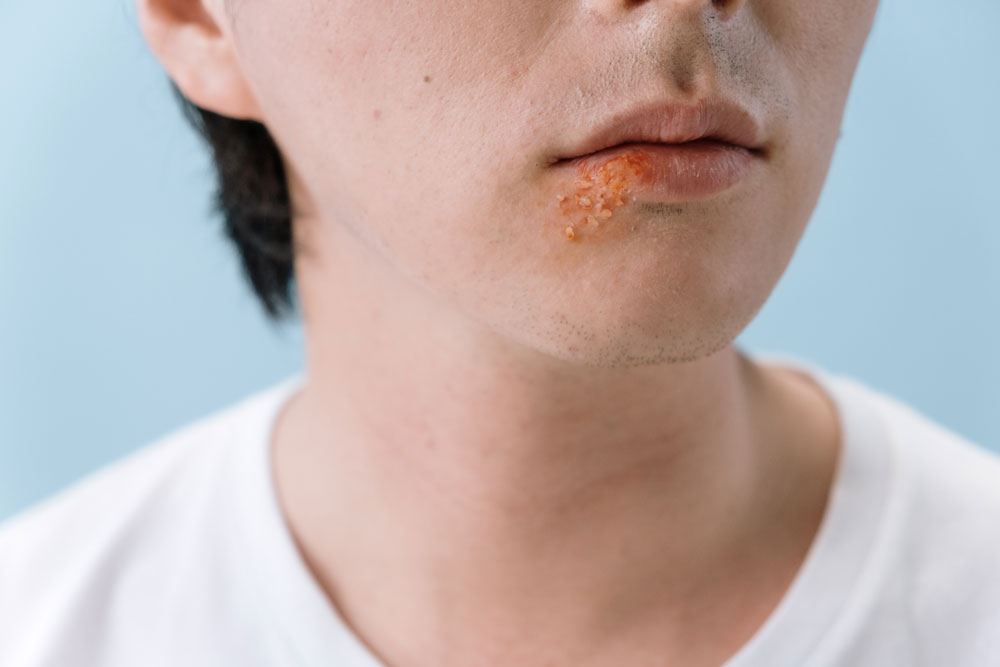 Read more about the article Dr Laurence and Shingles – 02-05-2021
