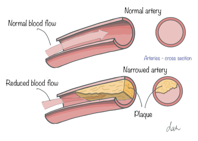 Understanding Cholesterol: Causes, Risks, Treatment 2 Understanding Cholesterol