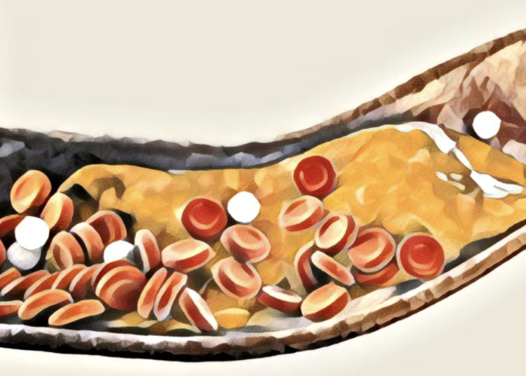 Read more about the article Understanding Cholesterol: Causes, Risks, Treatment