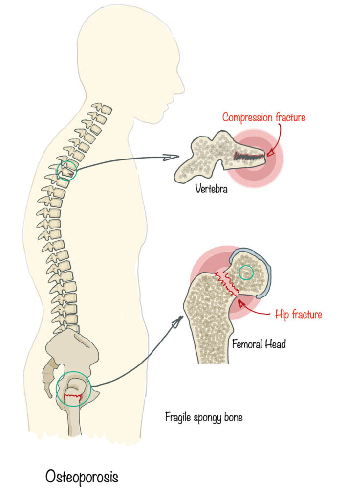 Osteoporosis