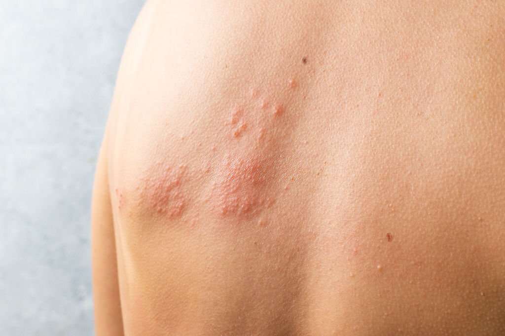 You are currently viewing Herpes Zoster (Shingles)