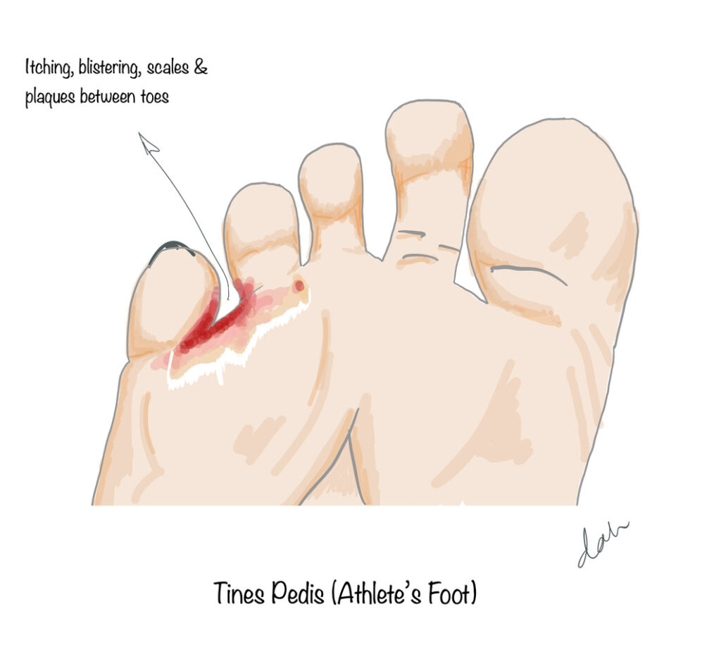 Tinea Pedis